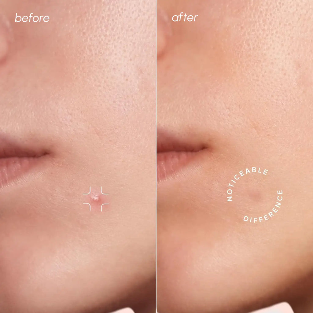 Invisible Pimple & Acne Patches Maree
