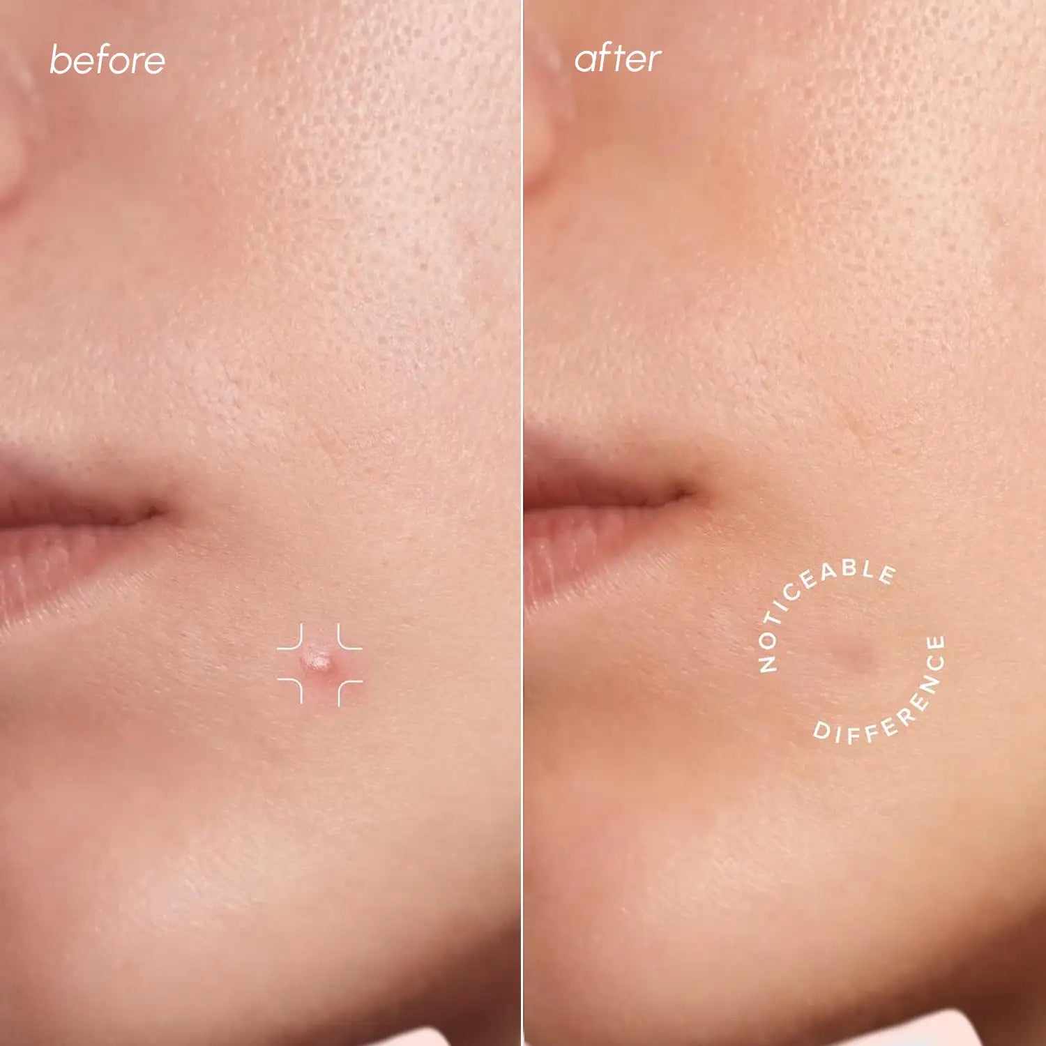 Invisible Pimple & Acne Patches Maree