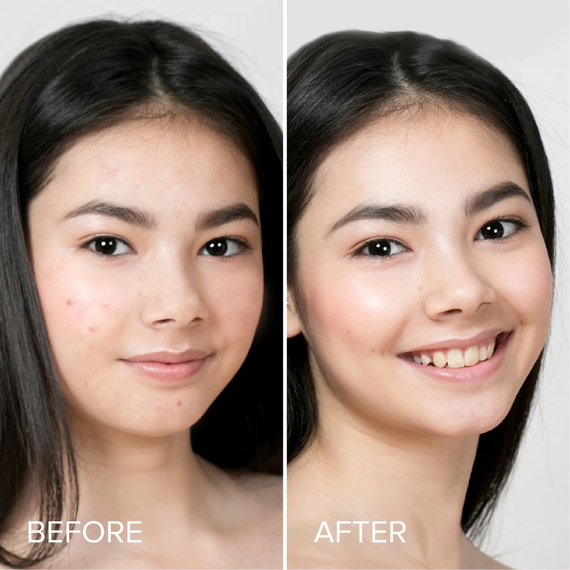 Pimple & Acne Patches Maree