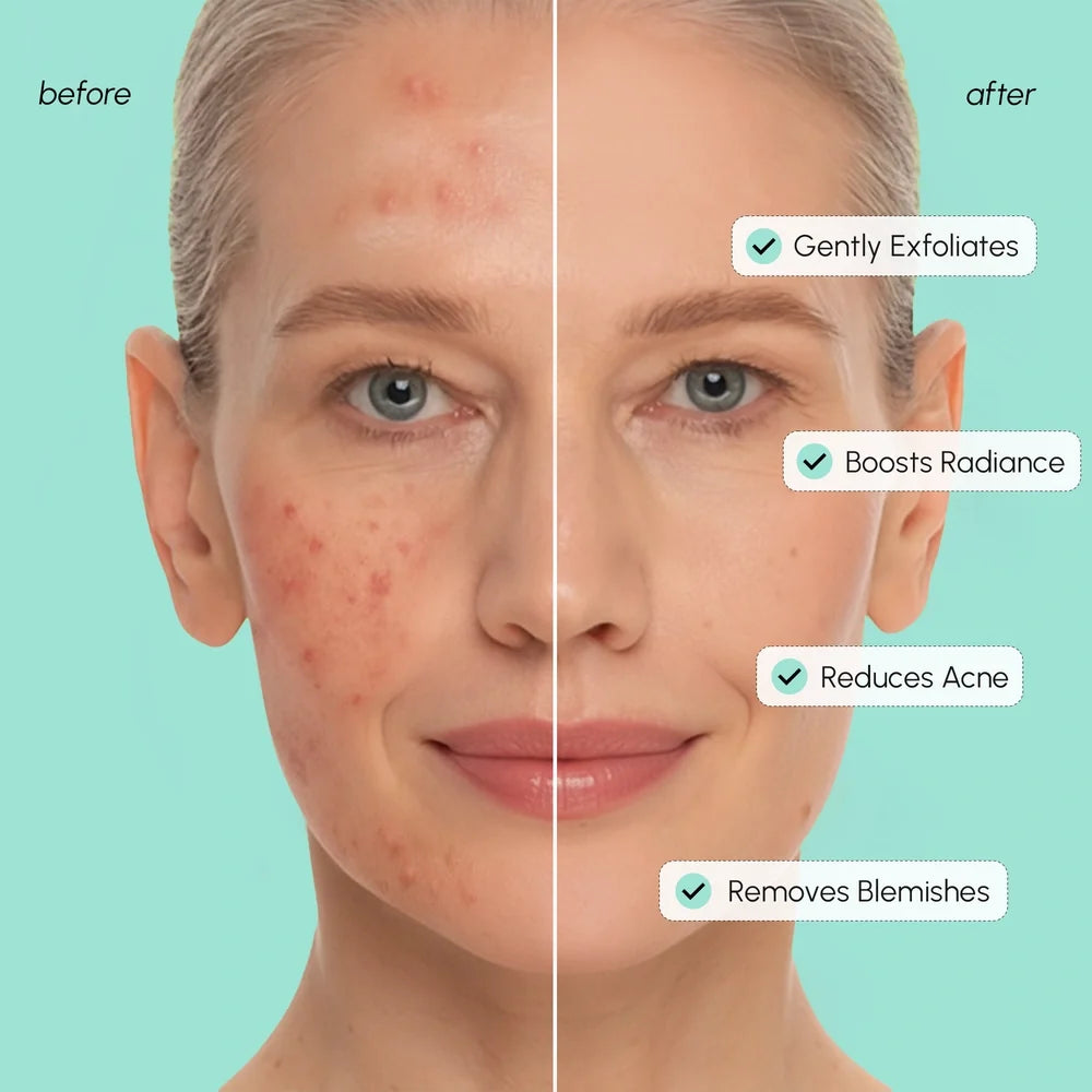 Azelaic Acid Soothing Pads Maree