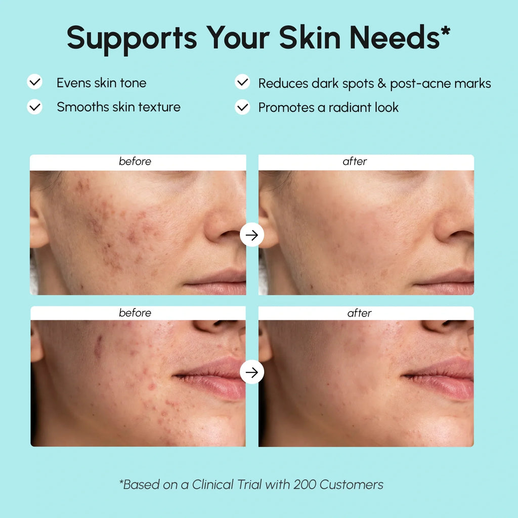 Azelaic Acid Cream for Sensitive Skin Maree
