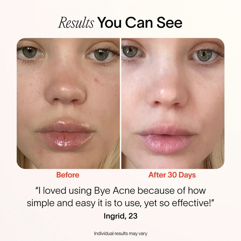 Bye Acne: 3-Minute Pimple Spot Treatment Solawave