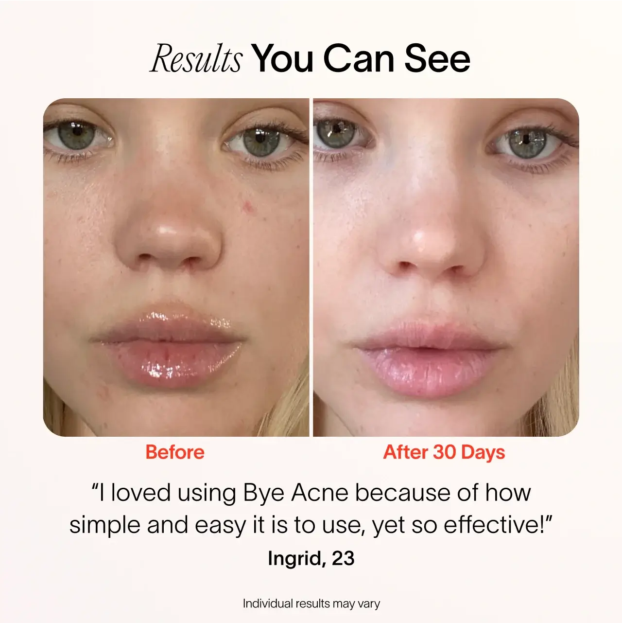 Bye Acne: 3-Minute Pimple Spot Treatment Solawave